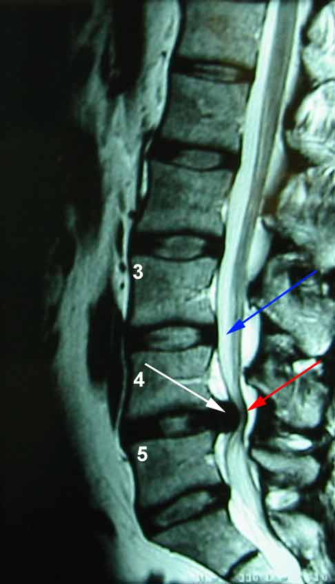 Bulging Disk L4 area