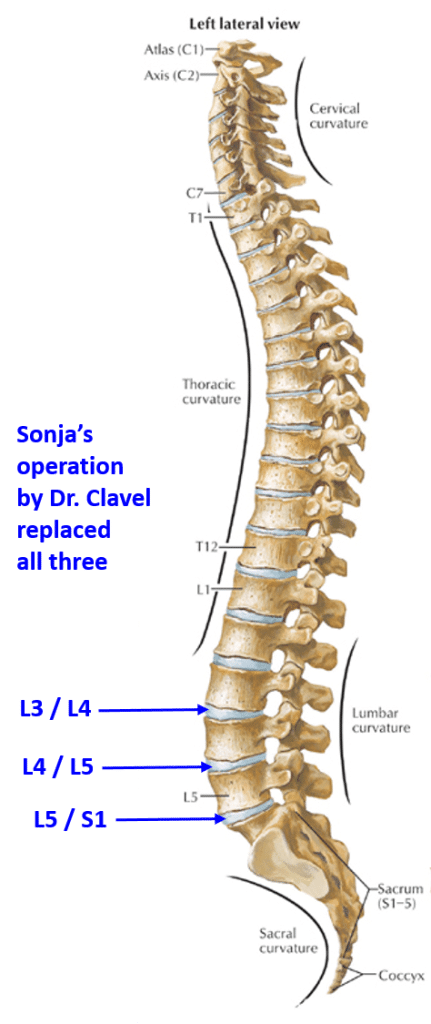 Sonja Operation by dr Clavel replaced L3L4L5S1 Disks