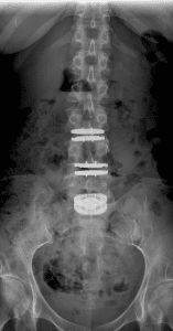 Xray Front ADR M6x3 Front si