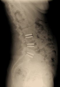 Xray Side ADR M6-L x3 Side